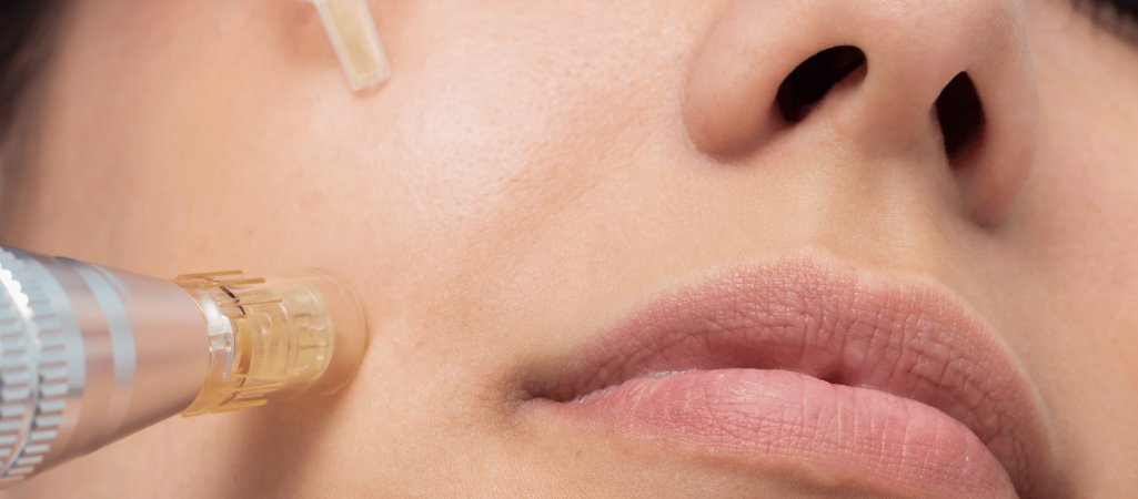 Micro needling Collagen Induction With L'esthetic Serum