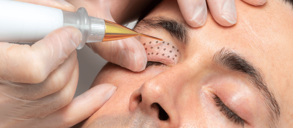 Plasma BT Treatment in Manchester