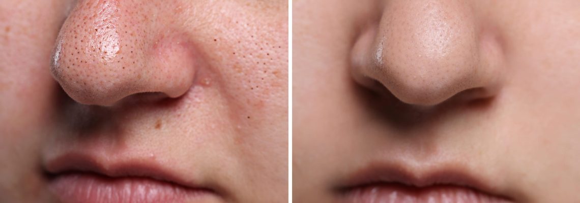 Pore Minimization Pore Minimization with Advanced Skin Rejuvenation