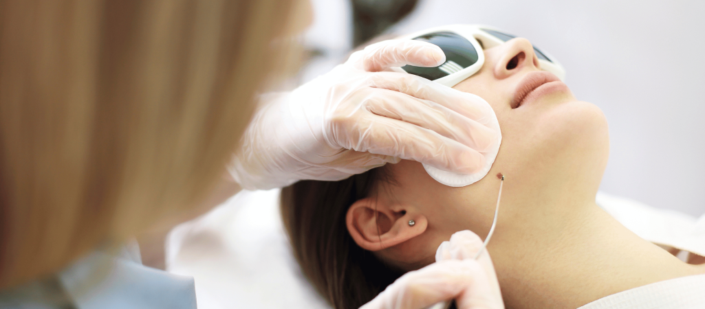 Skin Tag & Wart removal