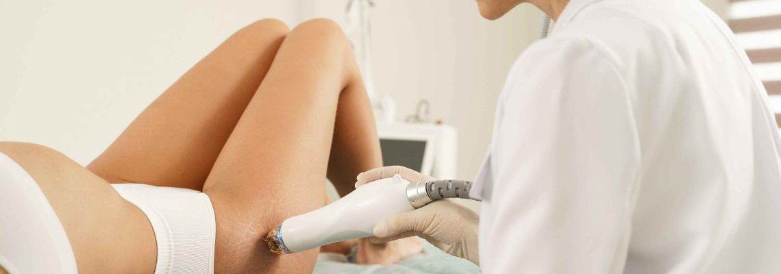 CO2 Laser Stretch Mark Removal in Manchester