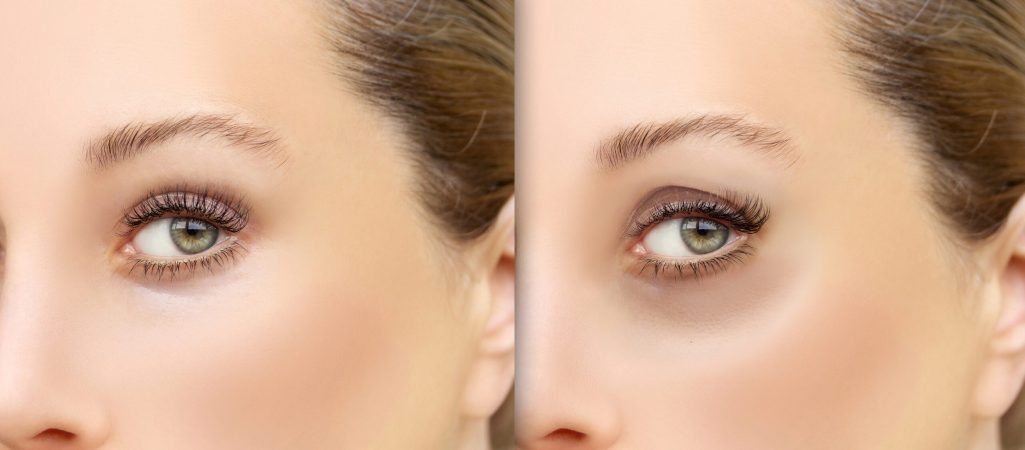 Tear Trough Fillers in Manchester