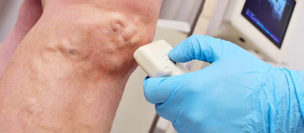 Thread Vein Removal in Manchester