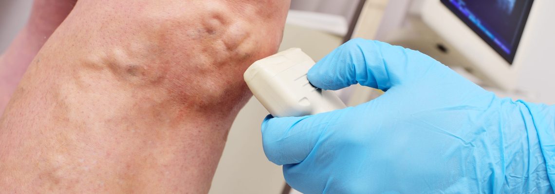 Varicose Vein Removal Thread Vein Removal in Manchester