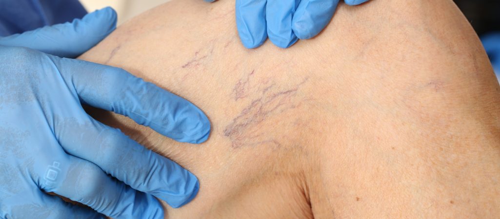 Microsclerotherapy treatment in Manchester.