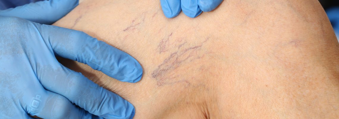 Microsclerotherapy treatment Microsclerotherapy treatment in Manchester.